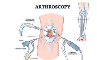 arthroscopy in Jalandhar arthroscopy