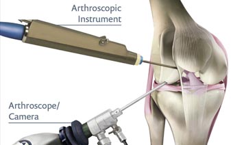 arthroscopy in Jalandhar arthroscopy