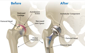 Joint Replacement