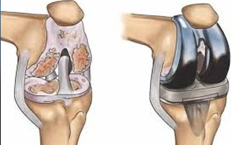 knee Replacement in Jalandhar knee Replacement