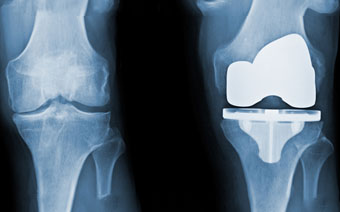 knee Replacement in Jalandhar Knee Replacement